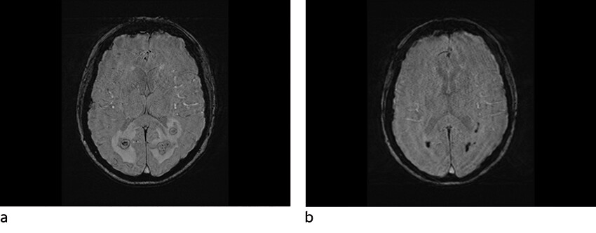 Figur 2 Susceptibilitetsvektet sekvens. a) Før behandling: signalbortfall i periferien samt i små foci sentralt. b) Etter…