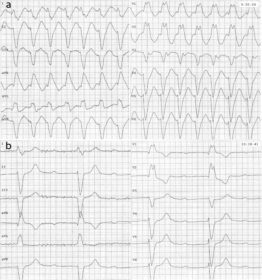 Figure 1 ECG taken at 50 minute intervals, showing the patient's fluctuating heart rhythm. Paper speed 50 mm/s. The times…