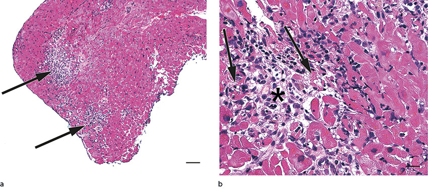 Figure 2 Haematoxylin-eosin- and saffron-stained myocardial biopsy section. a) Patchy inflammation infiltrates (arrows) are…