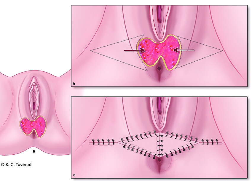 Figure 2 Illustration of how a wound defect in the perineum can be covered with bilateral advancement flaps. The wound…