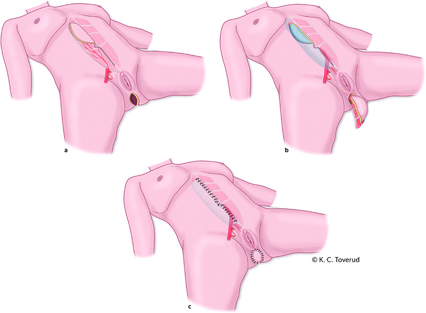 Figure 3 Wound defect after resection of the rectum and anus which has been reconstructed with a vertical rectus abdominis…