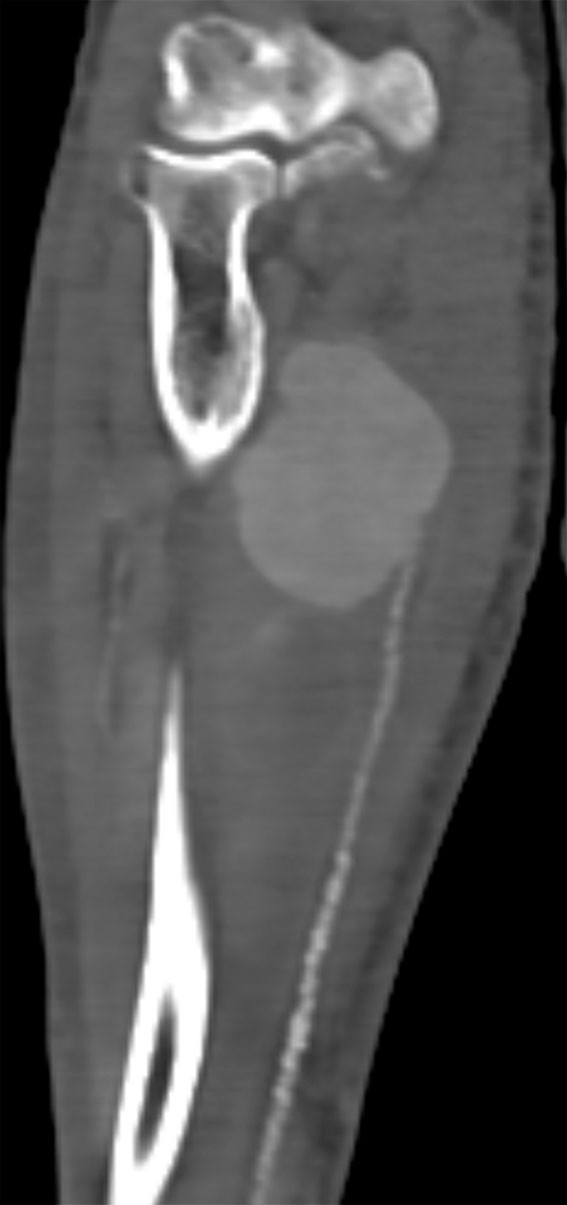 Figure 1 Preoperative CT angiography shows an aneurysm. Calcification and stenosis of the ulnar artery can be seen distal to…