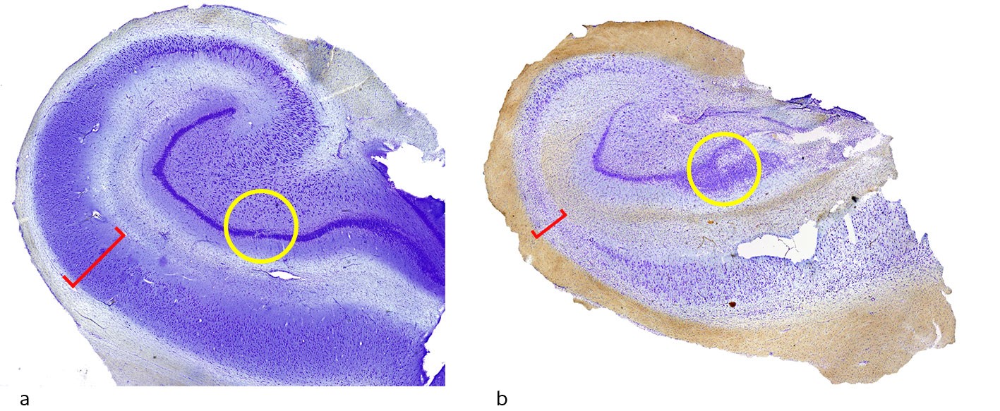 Figure 1 Cross-section of the hippocampus with Nissl staining of neurons. a) Normal hippocampus and b) sclerotic hippocampus…