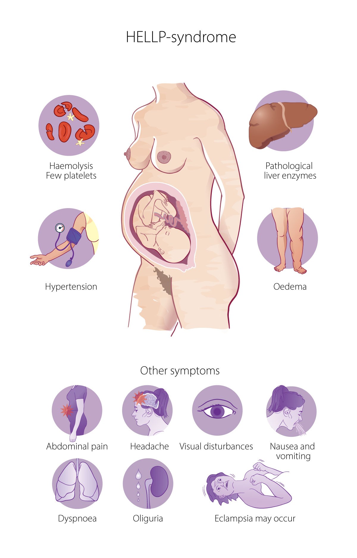Figure 1 Symptoms of HELLP syndrome. Not all symptoms are necessarily present, nor do the symptoms always appear at the same…