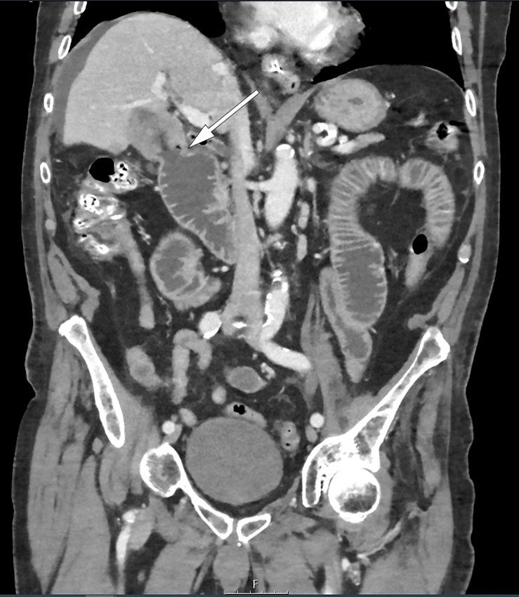 Figure 2 CT, coronal section. The arrow indicates a fistula between the gallbladder, which has abnormal wall thickening, and…