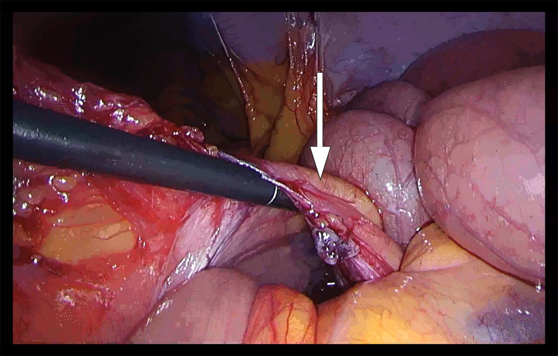 Figure 1 Laparoscopy with finding of left paraduodenal hernia. The arrow indicates the inferior mesenteric vein. Intestinal…