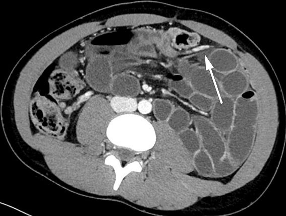 Figure 2 Axial section. Dilated ileum loops in left anterior pararenal space. Ascending branch of the left colic artery…
