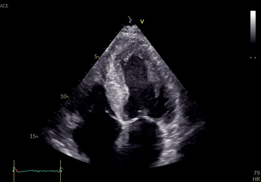 Figure 1 Echocardiography. Apical four-chamber view shows thickening of the left ventricular wall and a granular appearance…