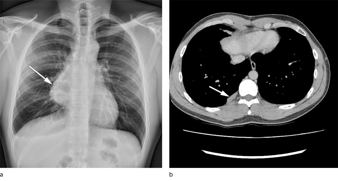 Figure 1 Diagnostic imaging. a) Chest X-ray with finding of mediastinal mass. b) Chest CT with pleural metastases two years…