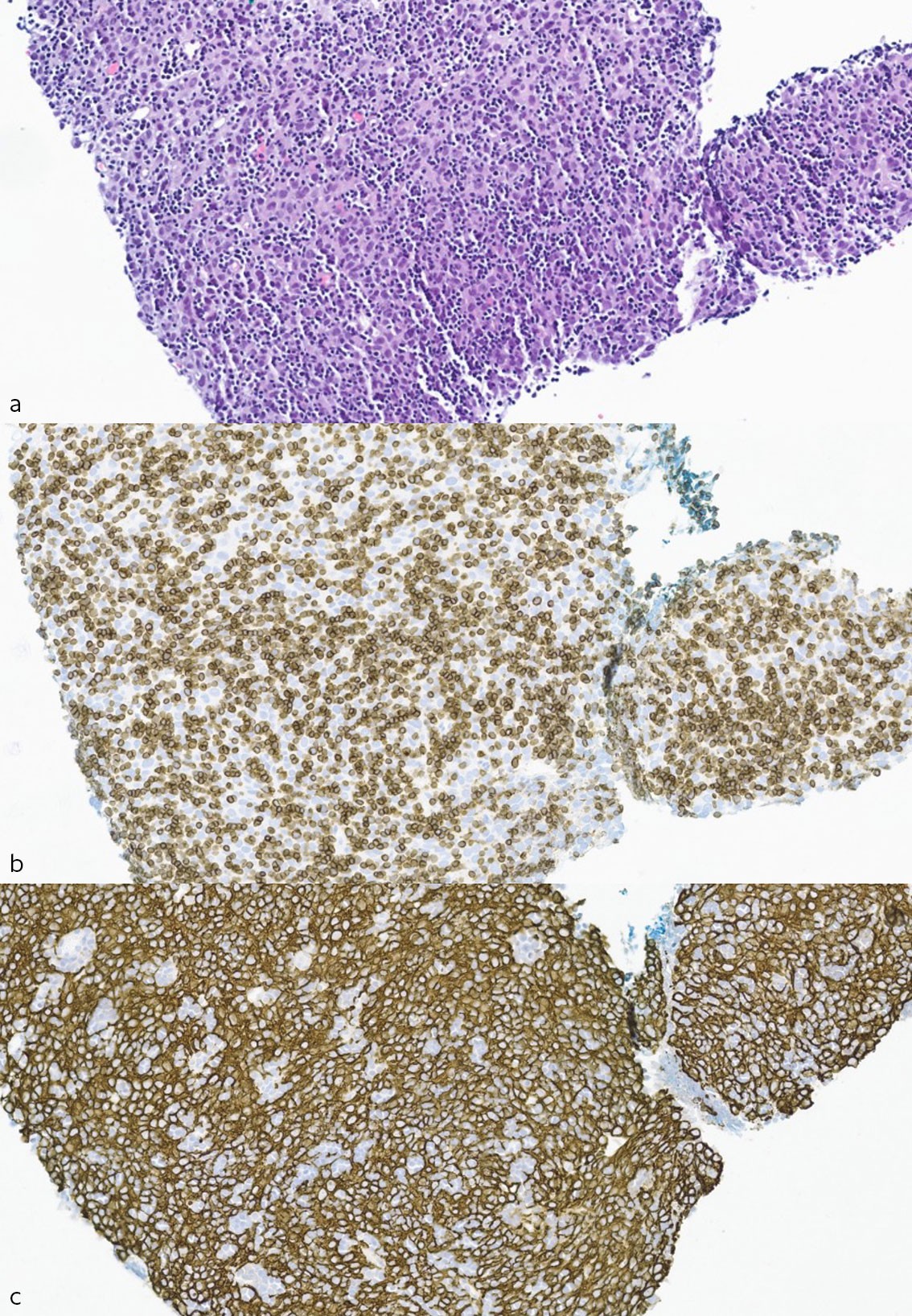 Figure 2 Section from the CT-guided biopsy of the pleural metastasis, approx. x400 magnification. a) Haematoxylin-eosin…