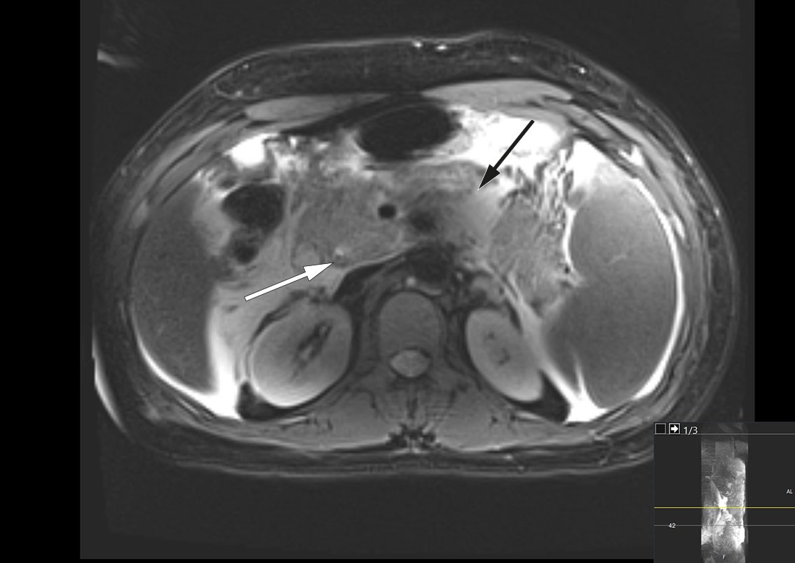 Figur 1 Magnetisk resonanskolangiopankreatografi (MRCP), transversalplan, tatt innleggelsesdag, viser et konkrement i ductus…