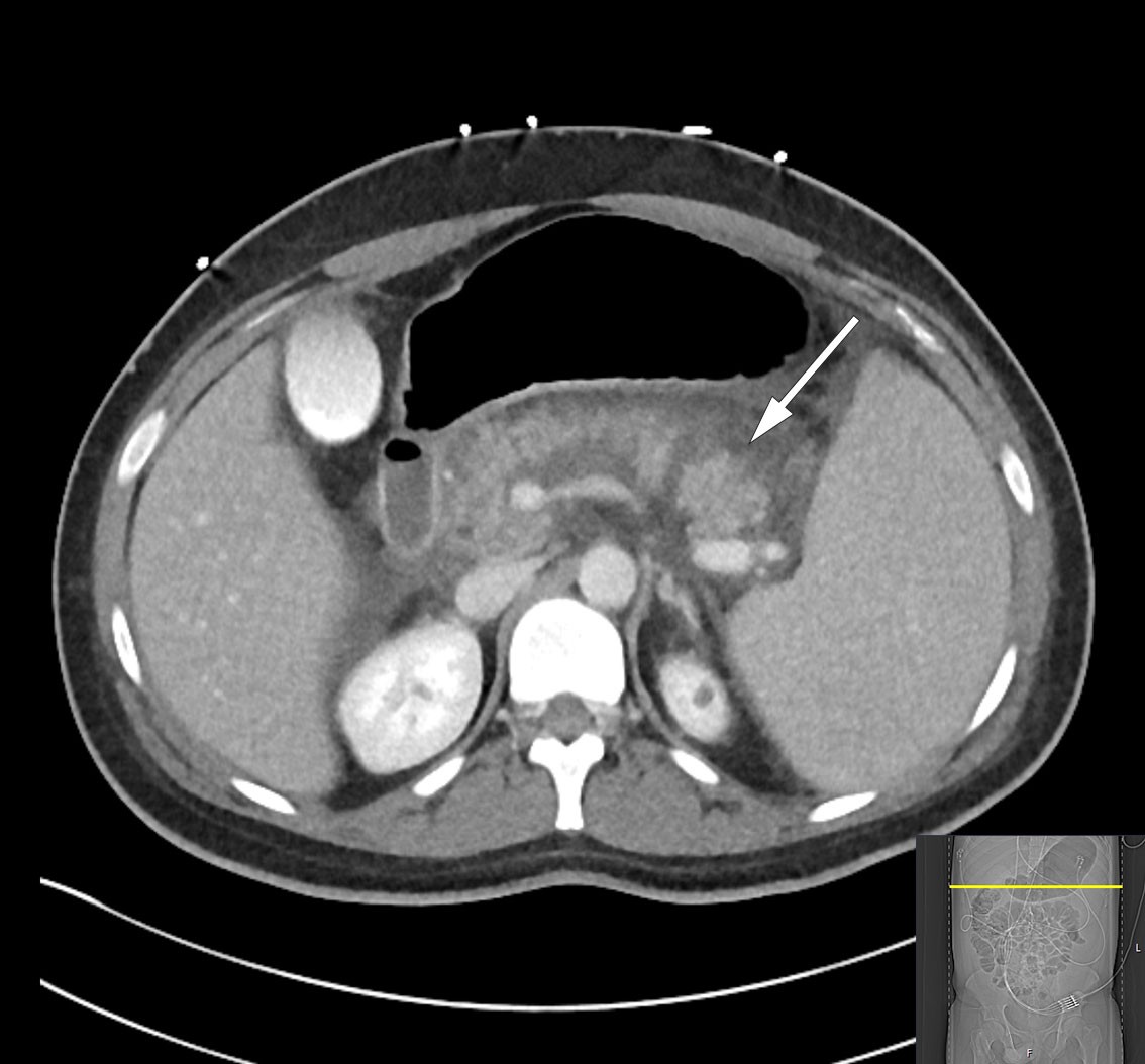 Figur 2 CT abdomen med intravenøs kontrast, transversalplan, tatt tredje døgn etter innleggelse, viser nekrotiserende…