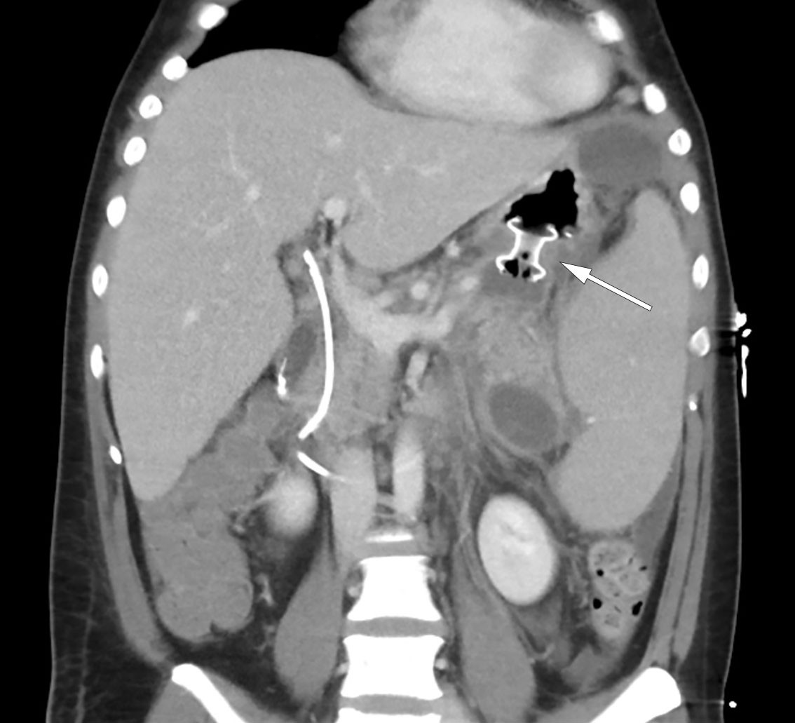 Figur 3 CT abdomen viser lumen-apposing metal stent (LAMS) av typen Hot AXIOS (pil), velfungerende drenasje og avtakende…