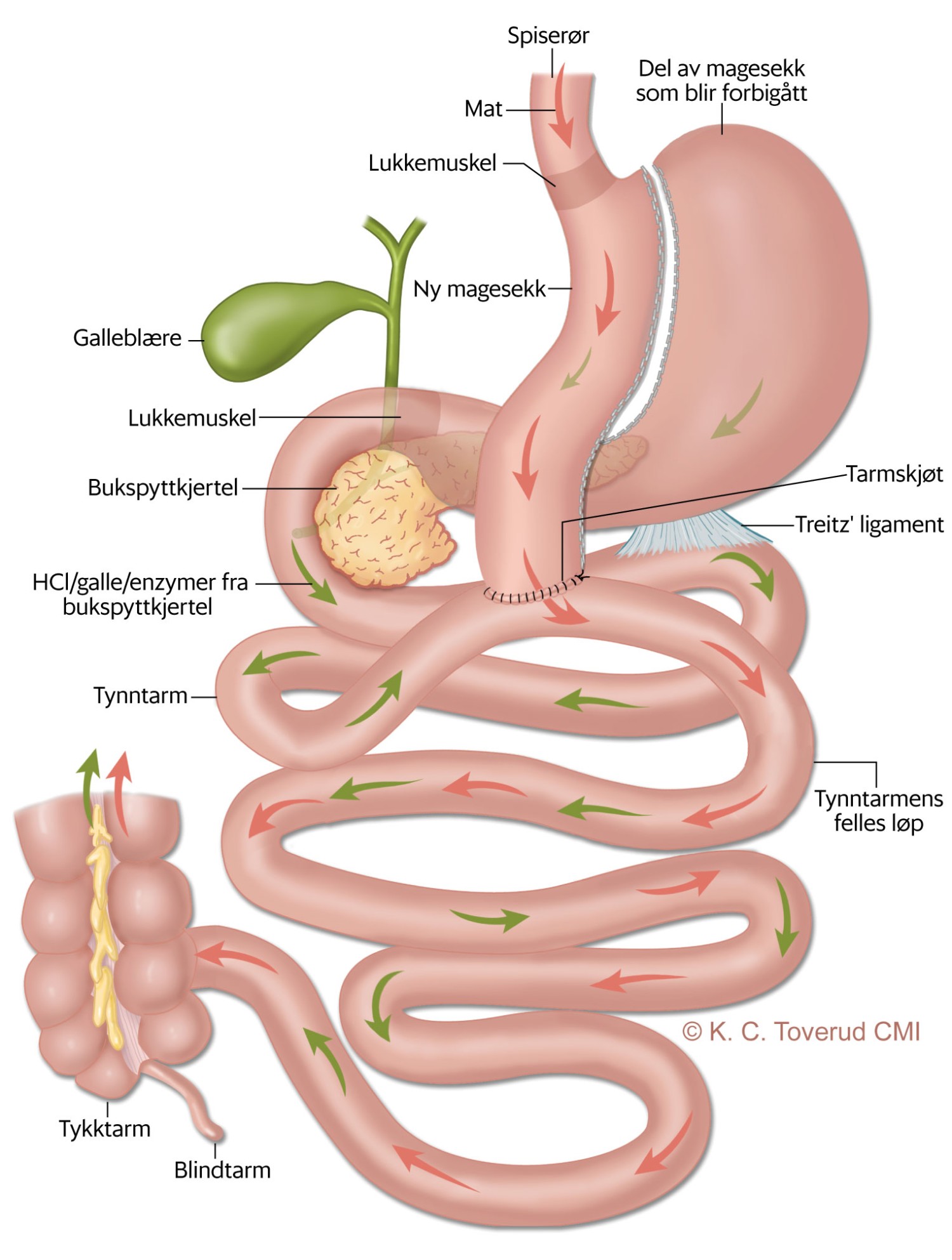 Figur 1 Mini-gastrisk bypass. Ved denne metoden deles magesekken slik at det etableres et langt ventrikkelrør, og det…