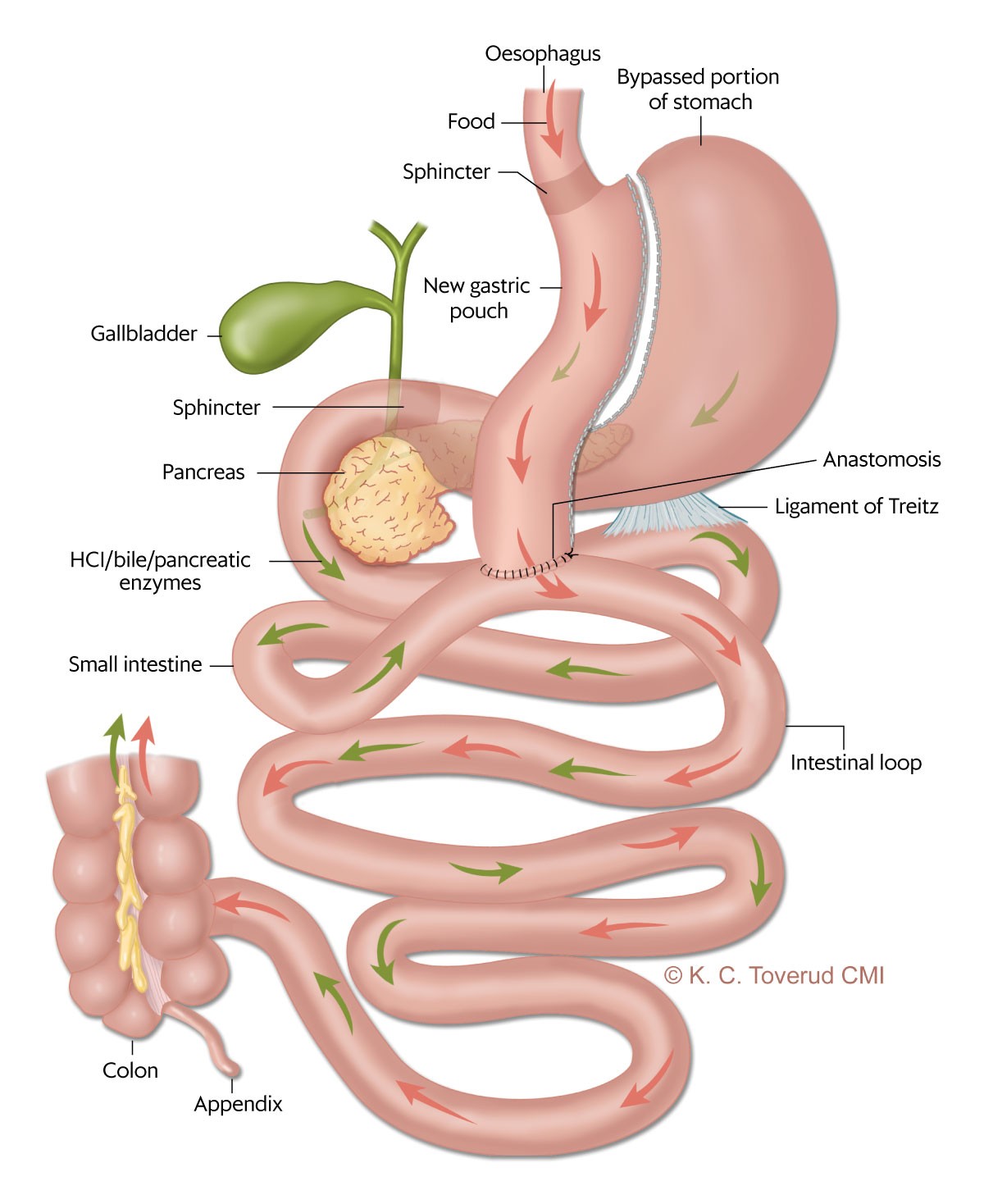 Figure 1 Mini-gastric bypass. With this method, the stomach is divided to create a long tube, with a single intestinal…