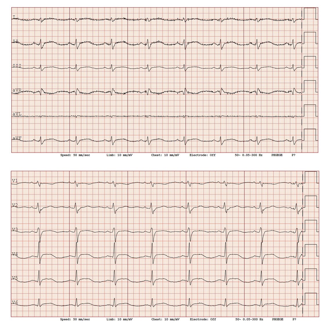 Figur 1 Første EKG på andre innleggelsesdag viste lett eleverte ST-segmenter i II, III og aVF, samt V3–V6.