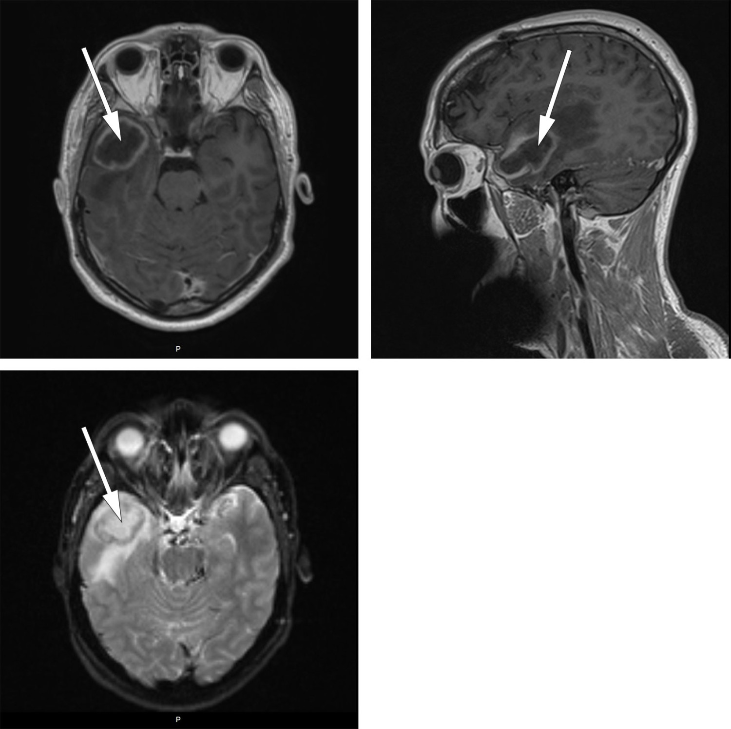 Figur 1 Preoperative MR-bilder viste abscess i høyre temporallapp. T1-vekting med kontrast i aksial- og sagittalplan (de to…