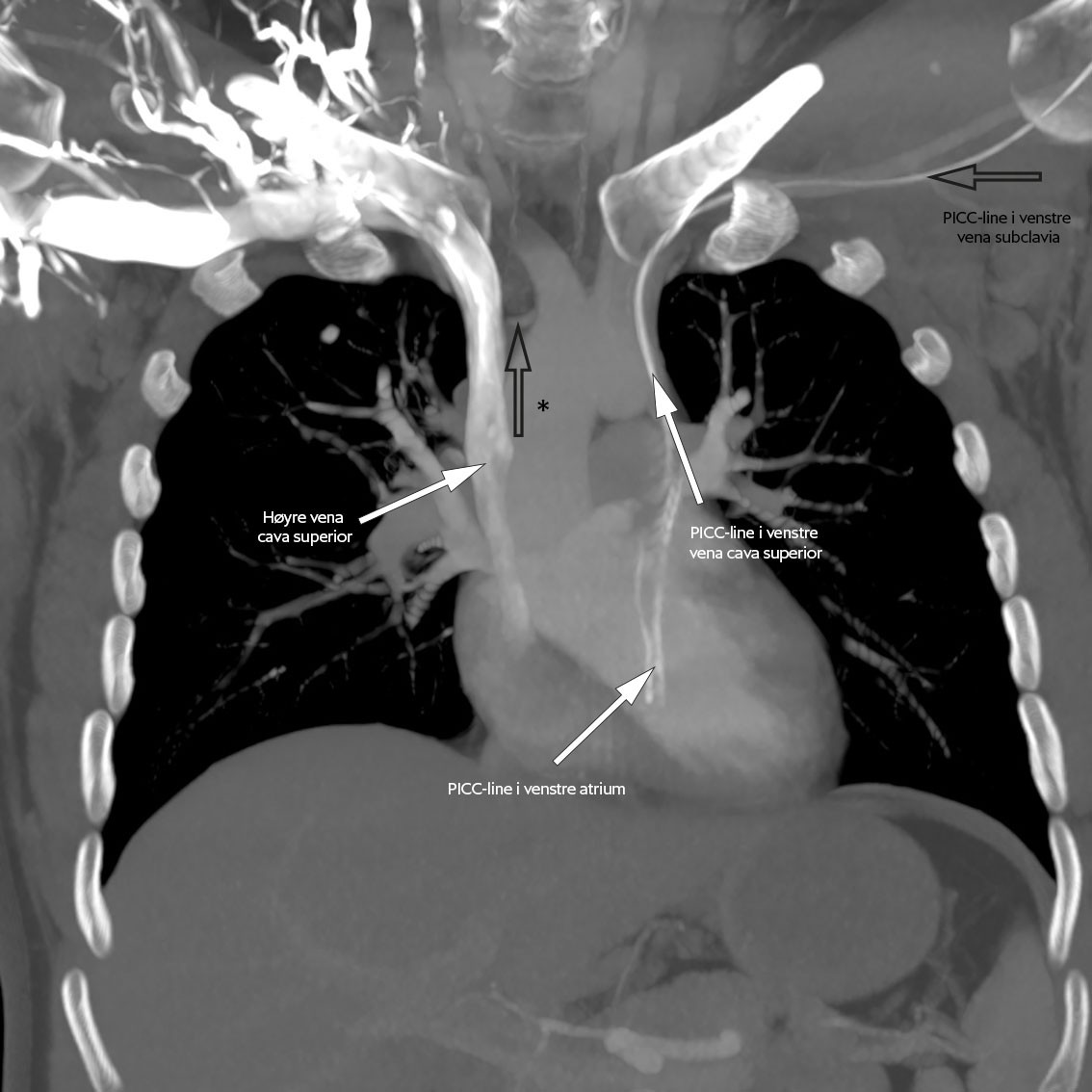 Figur 3a CT toraks med intravenøs kontrast, koronalplan med økt tykkelse av snitt. Man kan se at det foreligger en…