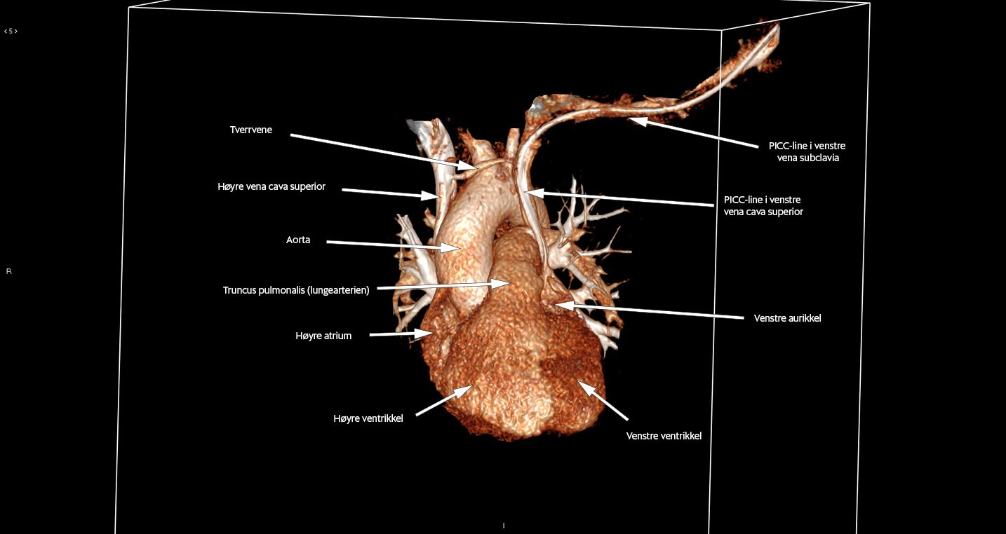 Figur 3b CT toraks, 3D-rekonstruksjon. Man ser tverrvene og sentralvenøst kateter i persisterende venstre vena cava superior.