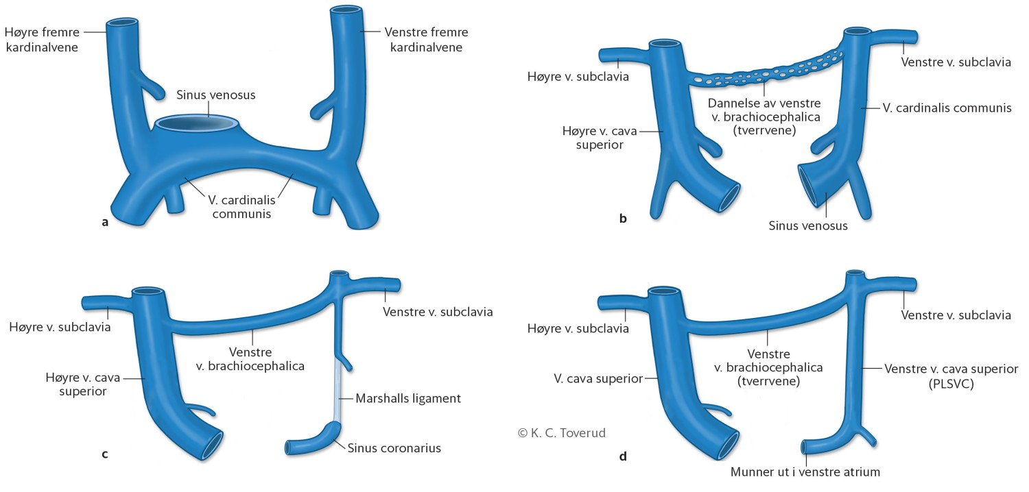 Figur 4 Normal embryologisk utvikling av venesystemet ved uke 5 (a), uke 7 (b) og uke 8 (c). Pasientens anomali er vist i…