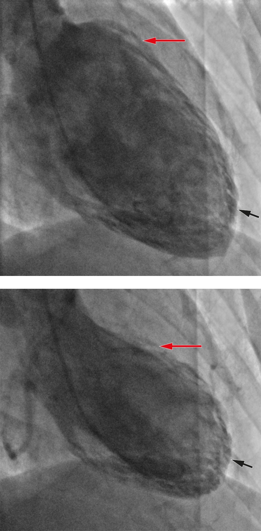 Figure 2 Ventriculography in end-diastole (top) and end-systole (bottom), respectively, showed basal hypercontractility (red…