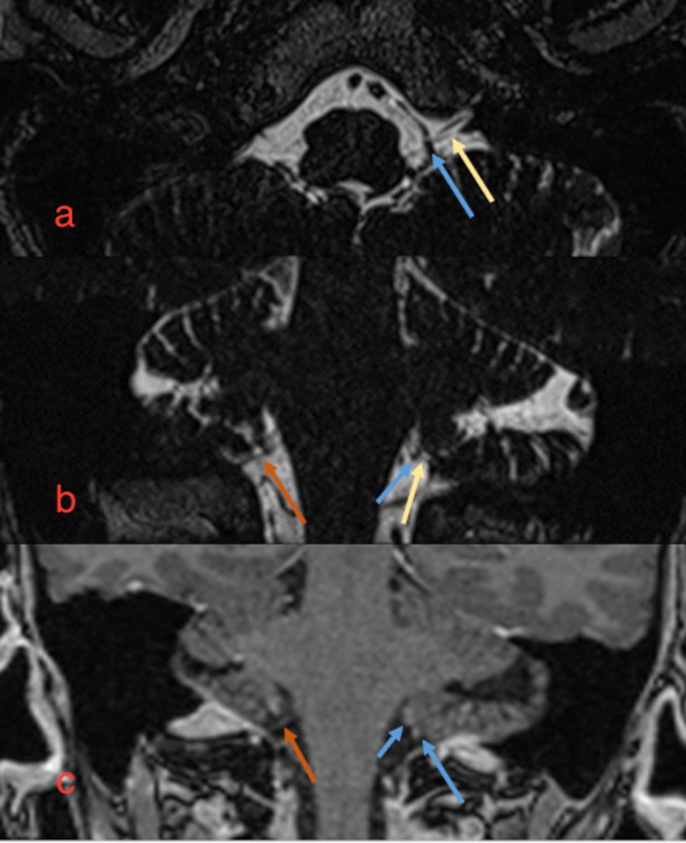 Figure 1 MR skull base, a) axial and b) coronal: T2 TSE sequence showed a normal course of the glossopharyngeal nerve on the…