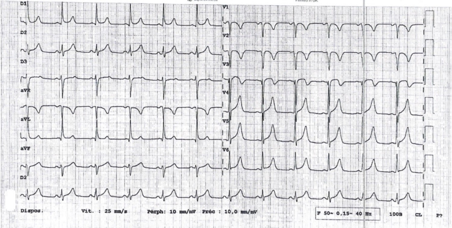 Figur 1 EKG av mann i 60-årene med deklive ødemer og progredierende funksjonsdyspné viser sinusrytme, frekvens 72/min,…