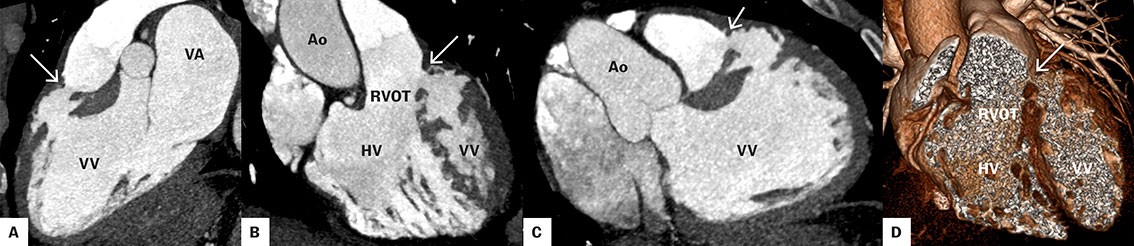 Figur 3 Computertomografi med kontrastvæske av hjerte i sagittalplan (A), koronalplan (B), transversalplan (C) og 3D…