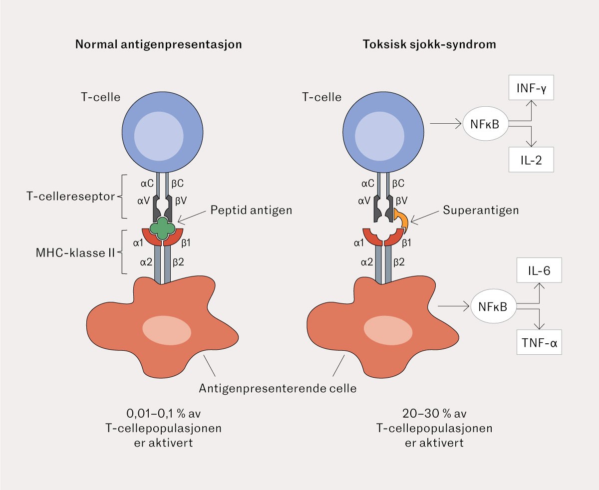 Figur 2 Skjematisk oversikt over normal T-celleaktivering og abnormal T-celleaktivering indusert av et superantigen …