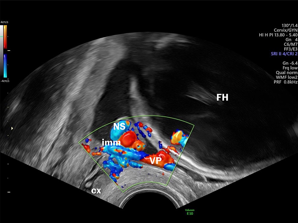 Figure 1 Vasa previa. Ultrasound image and video from a transvaginal ultrasound examination showing the cervix, lower edge…