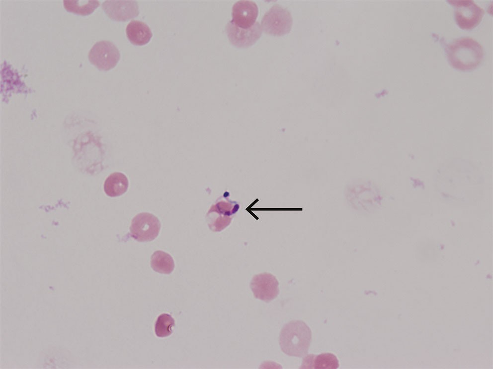 Figur 1 Giemsafarget utstryk av spinalvæske hos pasient med Chagas-encefalitt viser Trypanosoma cruzi-trypomastigot.