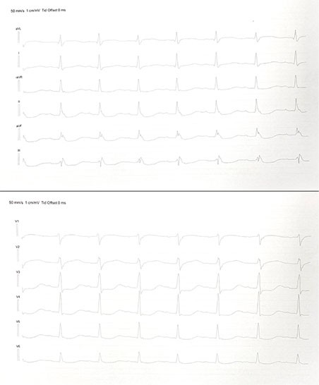 Figur 1 EKG viste sinusrytme med frekvens på 86/min, ST-depresjoner i avledning II, III, aVF og V3–V6 og forlenget QT-tid på…