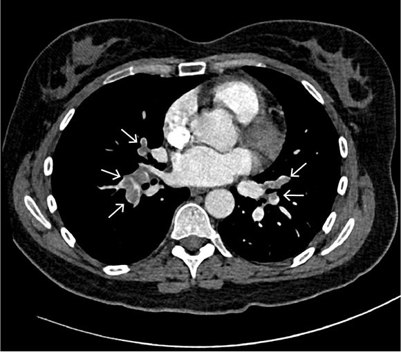 Figure 1 Axial section of CT pulmonary angiography showing contrast defects (arrows) in segmental pulmonary arteries…