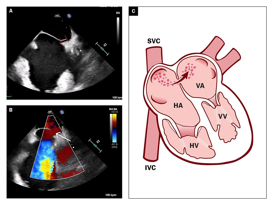Figur 3 Todimensjonal transøsofageal ekkokardiografi viser åpentstående foramen ovale (a, se striper) med spontan høyre-til…