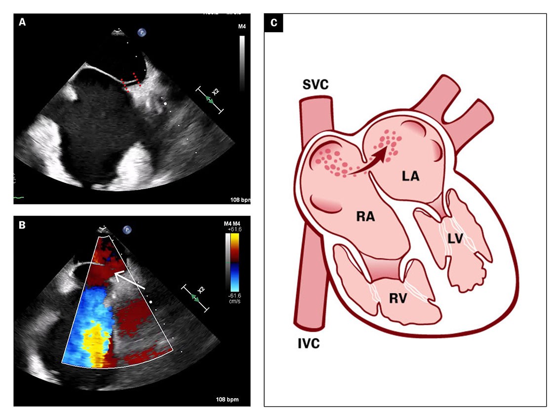Figure 3 2D transoesophageal echocardiogram shows patent foramen ovale (a, see stripes) with spontaneous right-to-left shunt…