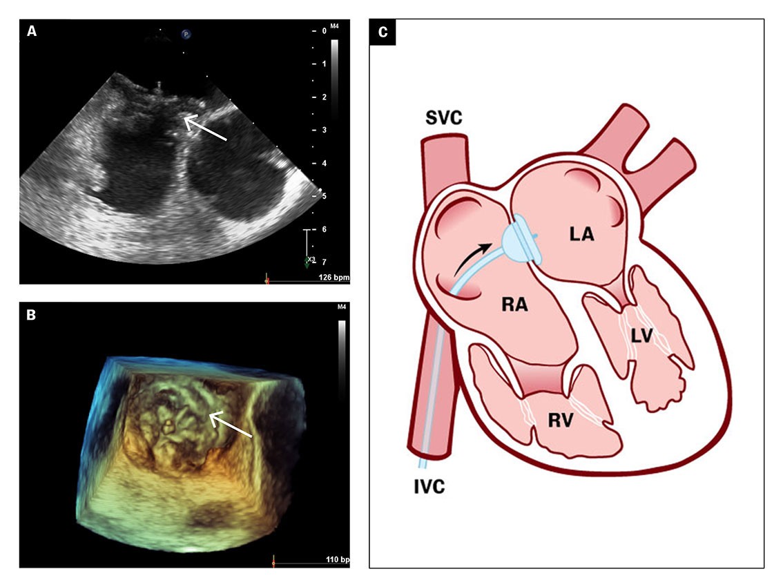 Figure 4 2D and 3D transoesophageal echocardiograms (a–b) show the outcome after closure of patent foramen ovale with a 30…