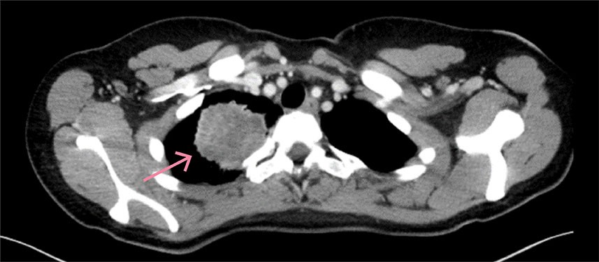 Figur 2 CT toraks. Tumor i høyre overlapp.