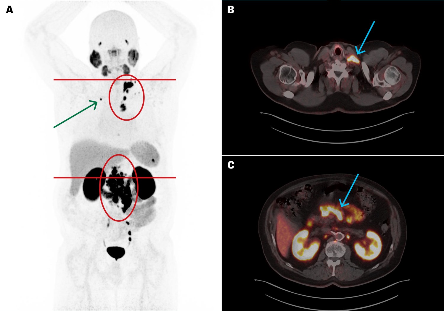 Figur 1 [⁶⁸Ga]PSMA-11 PET/CT før behandling med [¹⁷⁷Lu]PSMA-617 viste høyt opptak i spredte metastatiske lymfeknuter i…