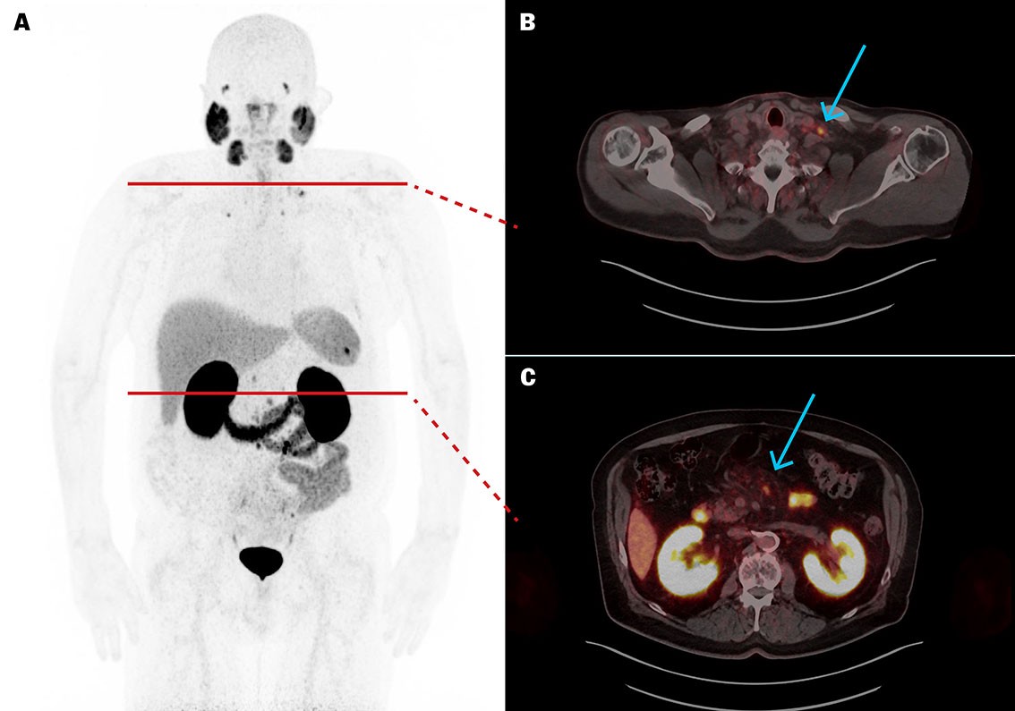 Figur 2 [⁶⁸Ga]PSMA-11 PET/CT etter fem behandlinger med [¹⁷⁷Lu]PSMA-617 viste betydelig størrelsesreduksjon av metastatiske…