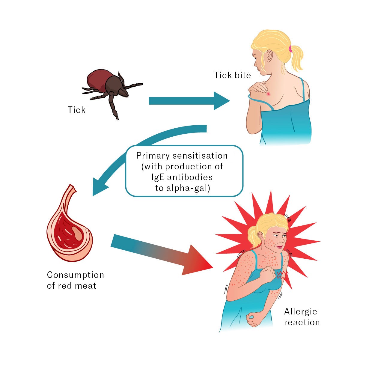 Figure 1 Primary sensitisation occurs during tick bites when the tick's saliva, which contains alpha-gal, is transferred to…