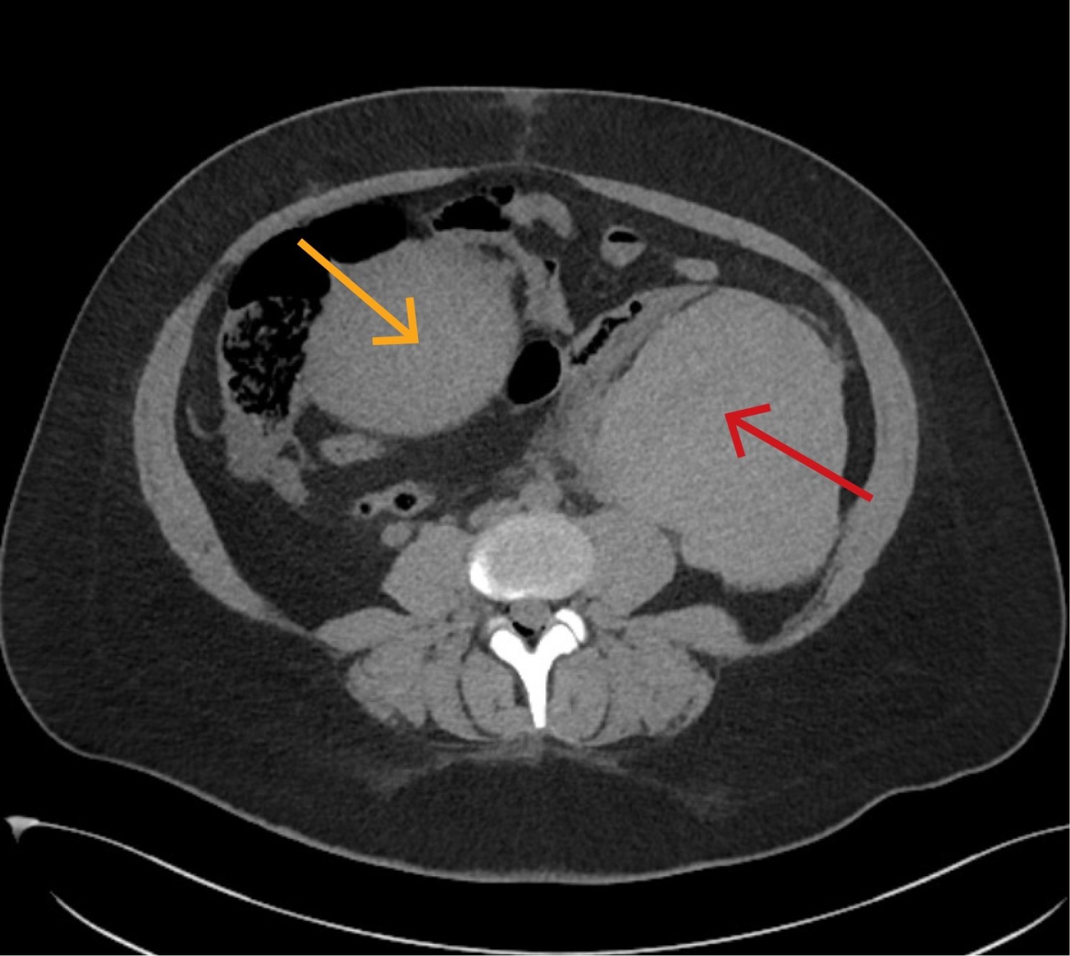 Figur 1 CT abdomen/bekken uten kontrast tatt etter fødsel ble beskrevet med intraperitonealt hematom (rød pil) på venstre…