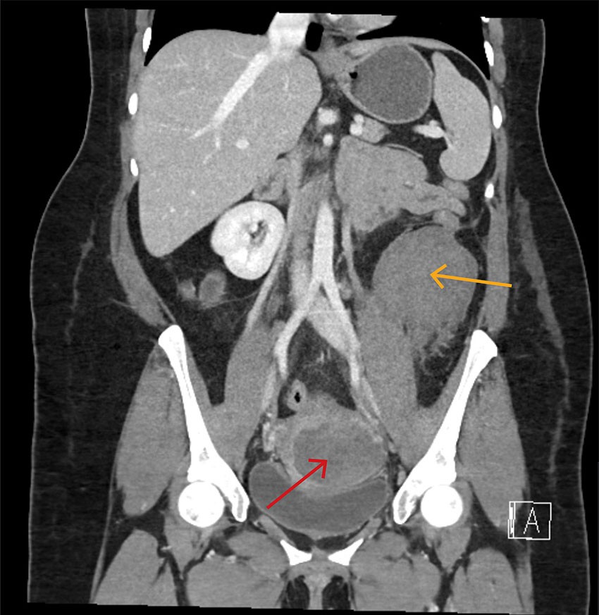 Figur 3 CT abdomen/bekken med kontrast i arteriell fase som viser hematom i cervix (rød pil) og venstresidig…
