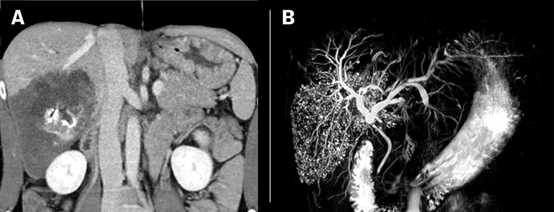 Figure 1 a) Patient with alveolar echinococcosis (patient 1). CT with contrast in venous phase with coronal reconstruction…