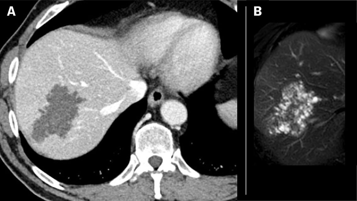 Figure 3 Patient with alveolar echinococcosis (patient 2). a) CT with contrast shows a well-defined, low attenuation lesion…