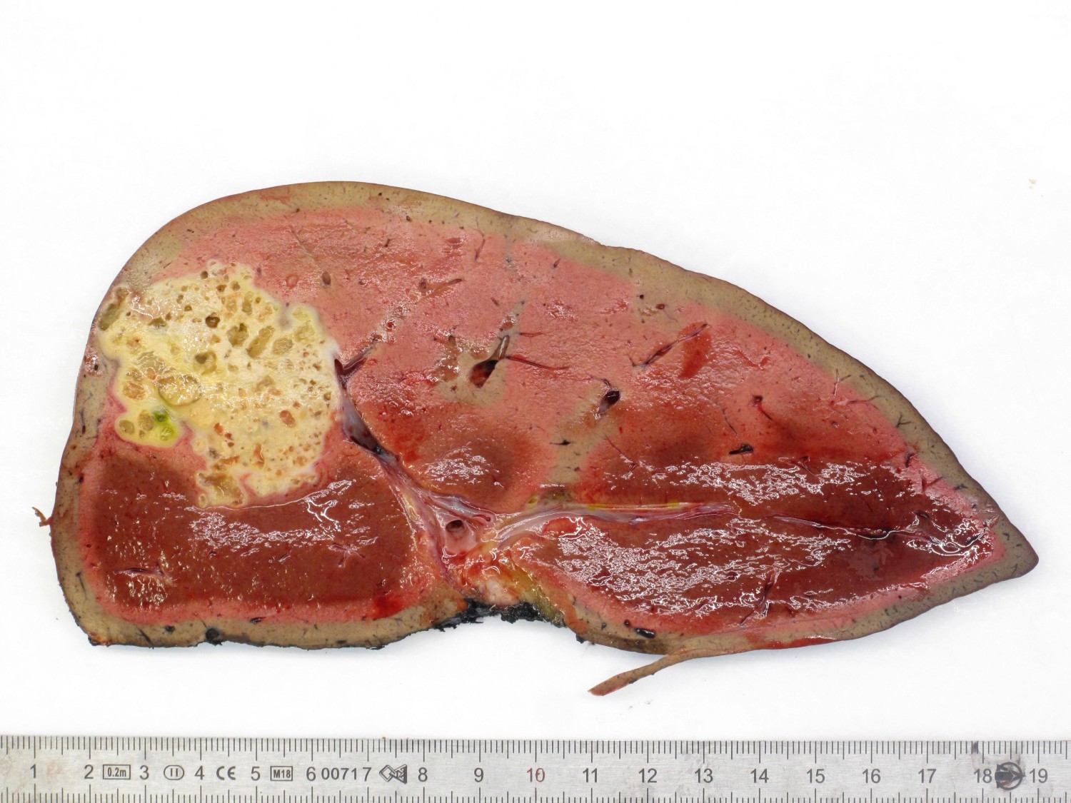 Figure 4 Surgical specimen with large multicystic tumour in liver segment 7 (patient 2).