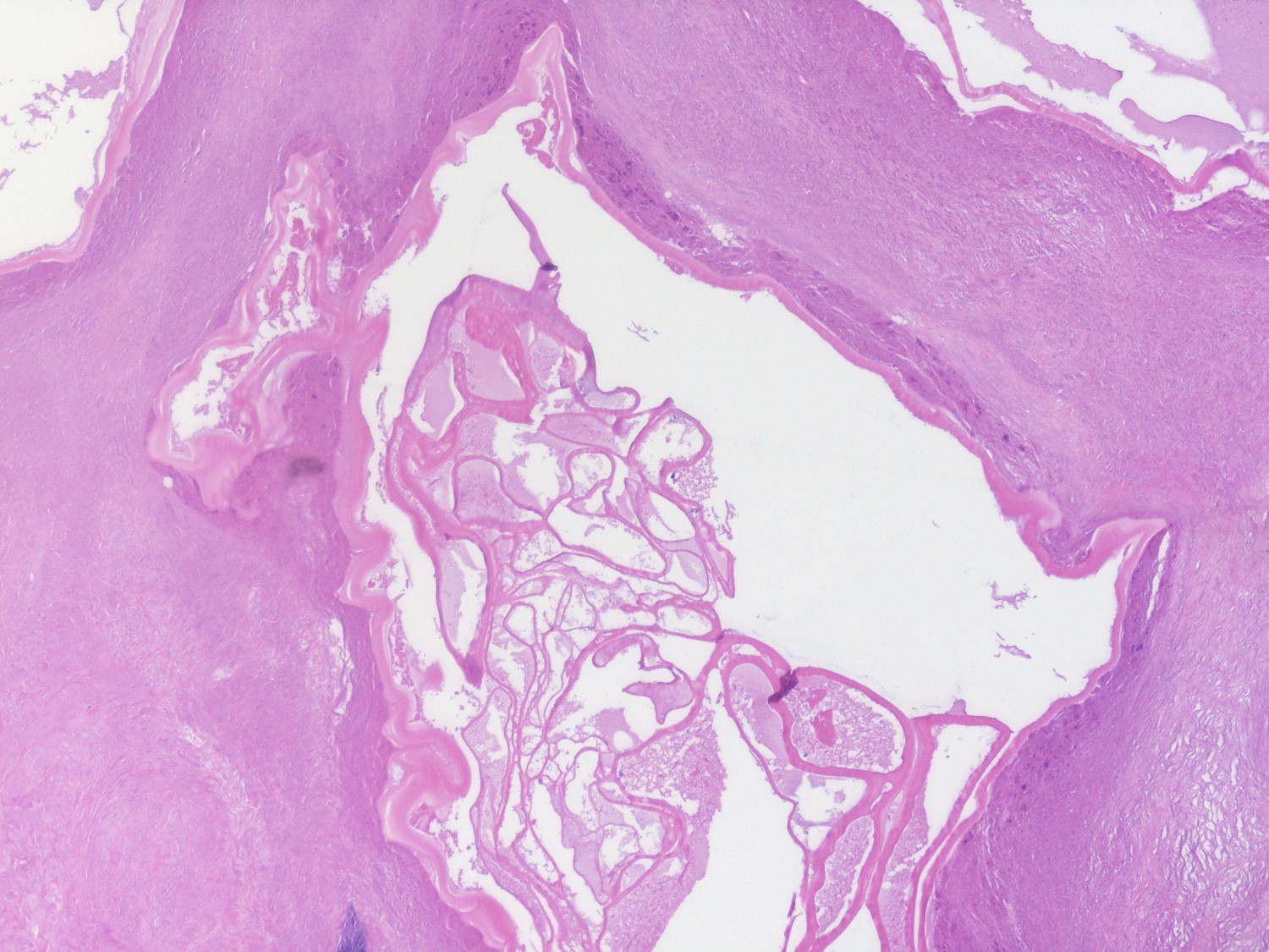 Figure 5 Histological examination of surgical specimen shows cysts with laminated membranes surrounded by fibrosis (patient…