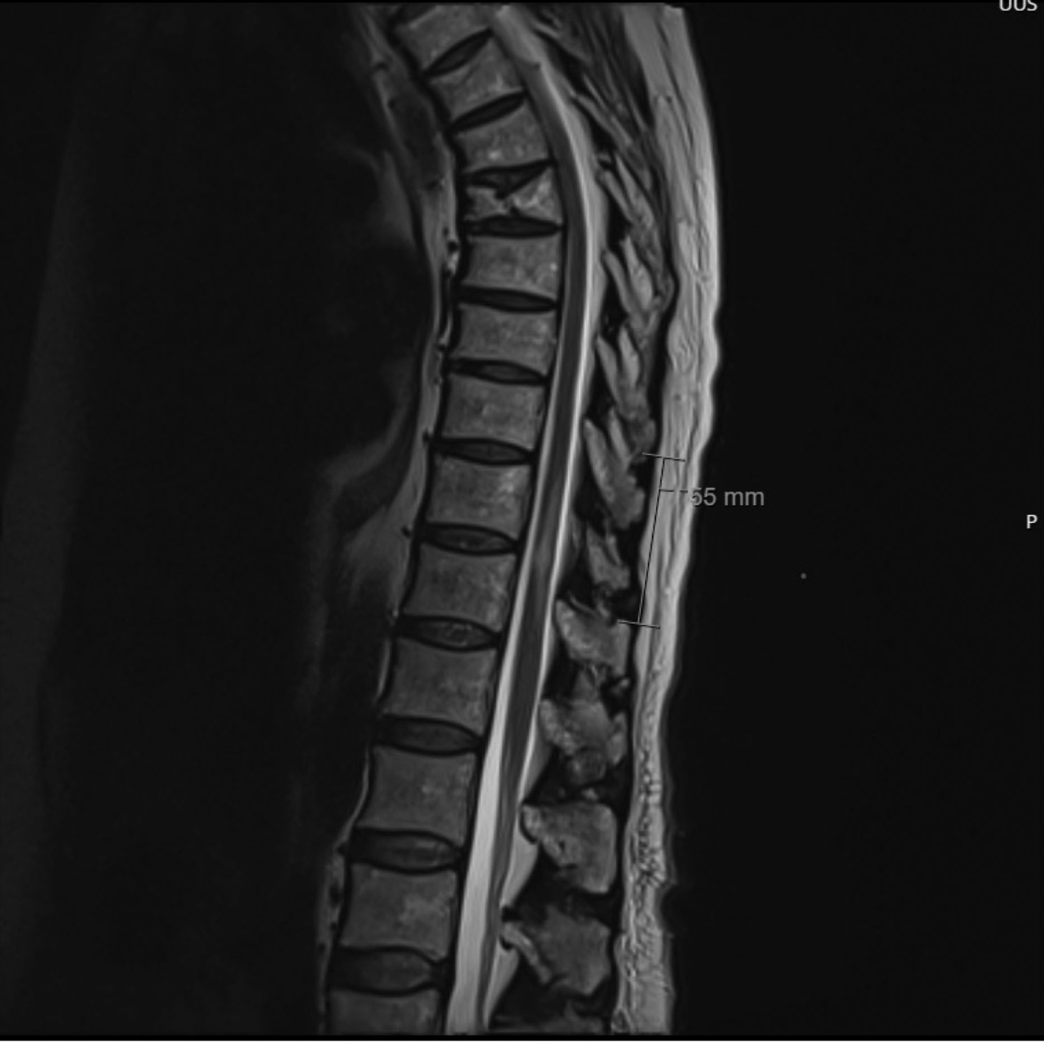 Figure 1 T2-weighted MRI image. T2 high-signal changes in the spinal cord at the Th11–Th12 levels can be observed. The…