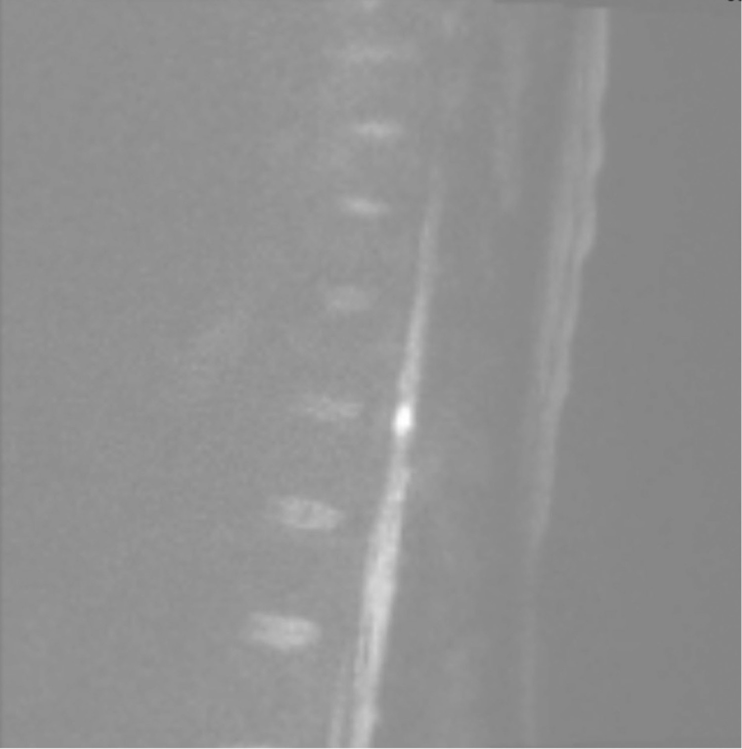 Figure 2 Diffusion-weighted MRI image shows hyperintensity at the Th11–Th12 levels, consistent with myelitis or stroke. The…