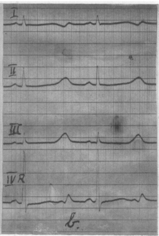 Figur 4 Faksimile fra artikkelen i American Heart Journal i 1957 (1). T-bølgen (over «b» i bildet) er sterkt forsinket. Den…
