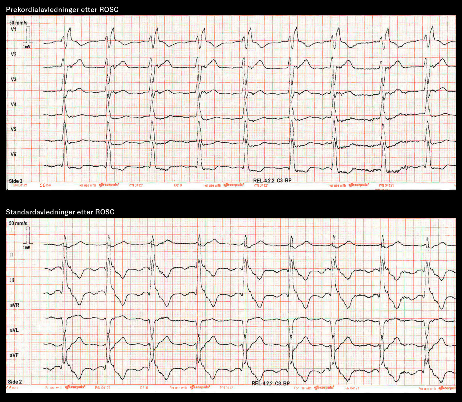 Figur 1 EKG etter autoresuscitering viste sinustakykardi og høyre grenblokk.